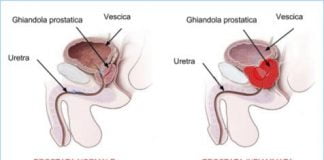 Prostatite cronica